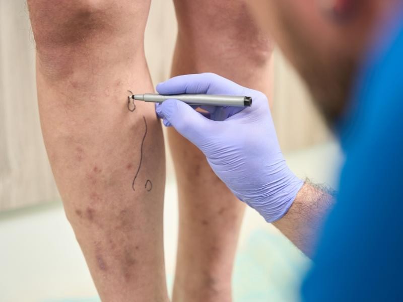 Tratamento de veias da mão com laser